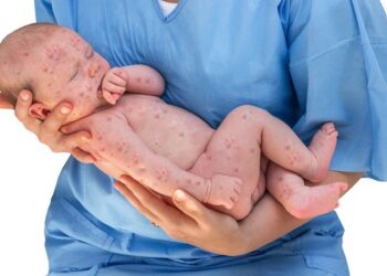 rubella disease: ಎಚ್ಚರ ತಪ್ಪಿದರೆ ದಾಂಗುಡಿಯಿಟ್ಟು ಕಾಡುತ್ತೆ ದಡಾರ!