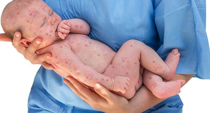 rubella disease: ಎಚ್ಚರ ತಪ್ಪಿದರೆ ದಾಂಗುಡಿಯಿಟ್ಟು ಕಾಡುತ್ತೆ ದಡಾರ!